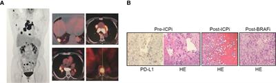 Durable Response to the Combination of Atezolizumab With Platinum-Based Chemotherapy in an Untreated Non-Smoking Lung Adenocarcinoma Patient With BRAF V600E Mutation: A Case Report